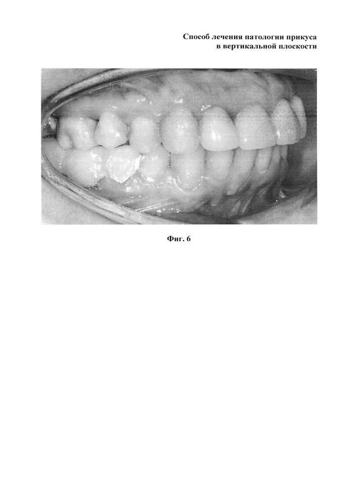 Способ лечения патологии прикуса в вертикальной плоскости (патент 2617181)