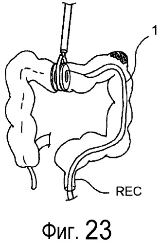 Устройство и способ резекции и смыкания полого органа (патент 2497469)