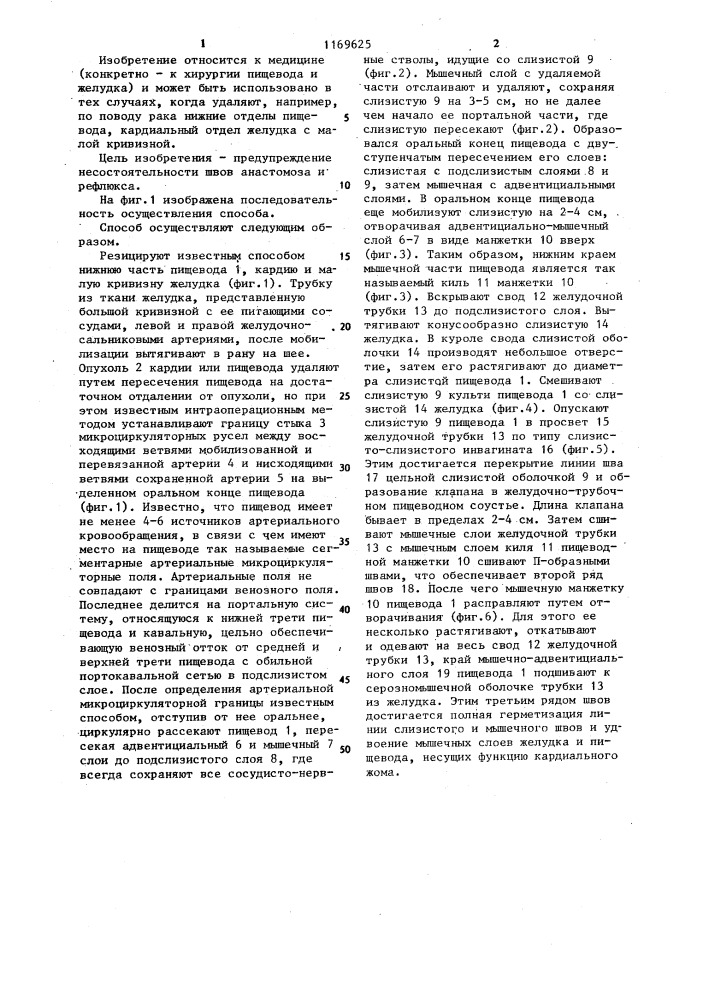 Способ формирования пищеводно-желудочного анастомоза (патент 1169625)