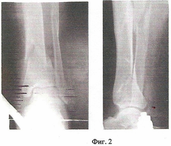 Способ консервативного лечения переломов костей голени (патент 2465858)