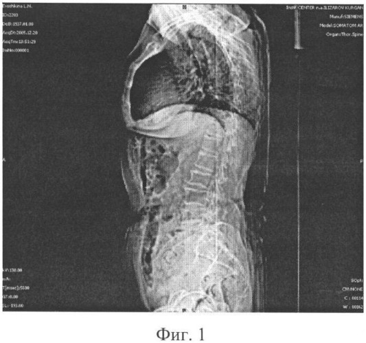 Способ определения риска остеопоротических переломов в грудном отделе позвоночника (патент 2376935)