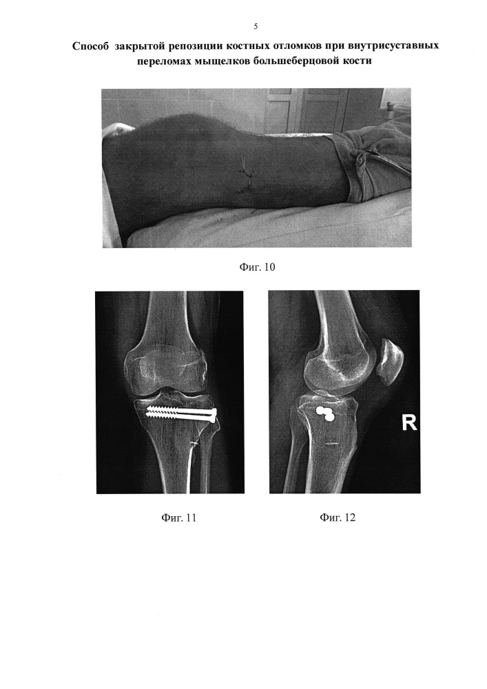 Способ закрытой репозиции костных отломков при внутрисуставных переломах мыщелков большеберцовой кости (патент 2625651)
