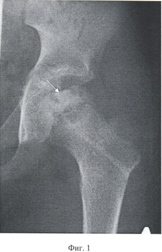 Способ лечения дистрофических изменений головки бедренной кости у детей (патент 2454975)