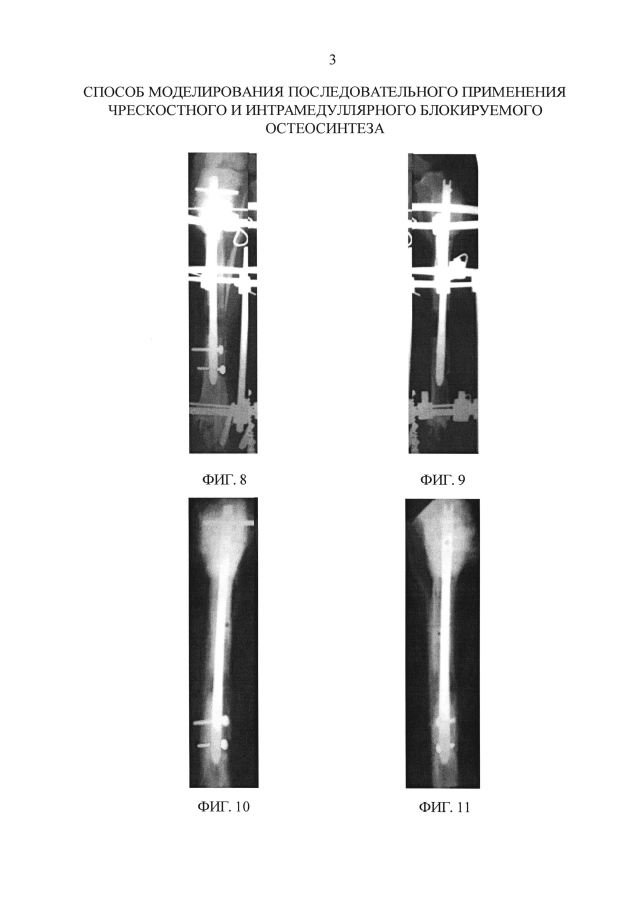 Способ моделирования последовательного применения чрескостного и интрамедуллярного блокируемого остеосинтеза (патент 2593583)