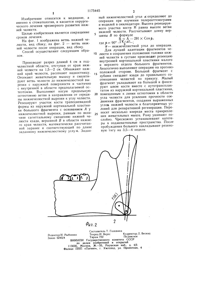 Способ лечения прогнатии нижней челюсти (патент 1175445)
