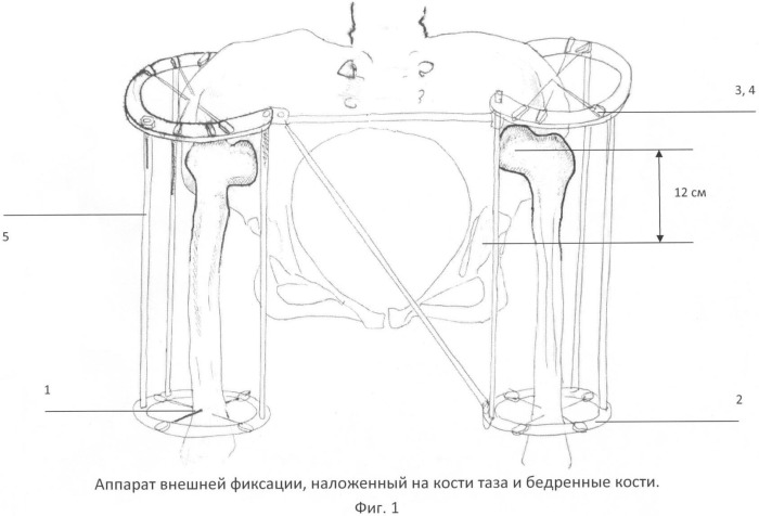 Способ одноэтапного двустороннего эндопротезирования тазобедренных суставов при двустороннем диспластическом коксартрозе с полным вывихом и высоким смещением головок бедренных костей (патент 2397720)