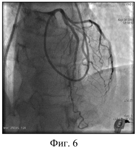 Способ катетеризации коронарных артерий и катетер для его реализации (патент 2556778)