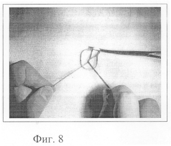 Способ наложения лигатуры (патент 2246269)