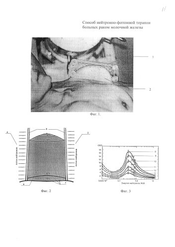 Способ нейтронно-фотонной терапии больных раком молочной железы (патент 2582214)