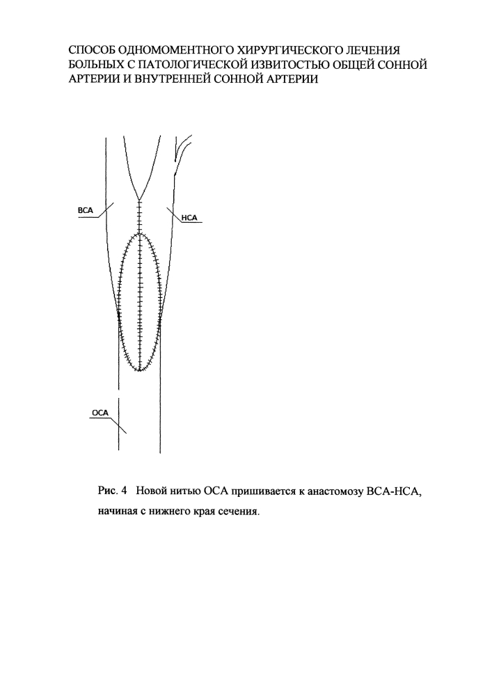 Способ одномоментного хирургического лечения больных с патологической извитостью общей сонной артерии и внутренней сонной артерии (патент 2618209)