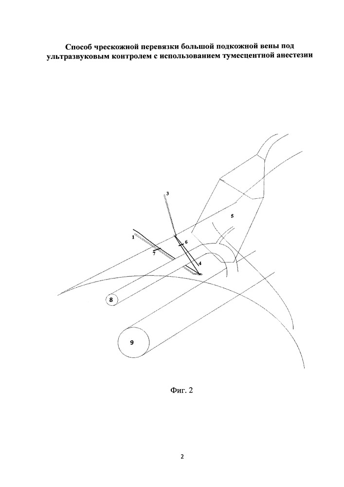 Способ чрескожной перевязки большой подкожной вены под ультразвуковым контролем с использованием тумесцентной анестезии (патент 2651081)