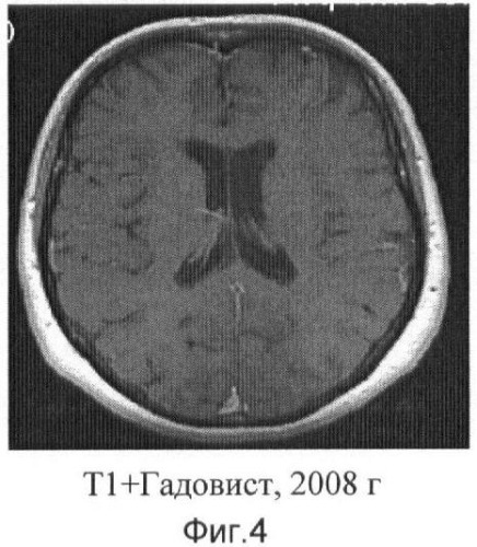 Способ лечения рассеянного склероза (патент 2390334)