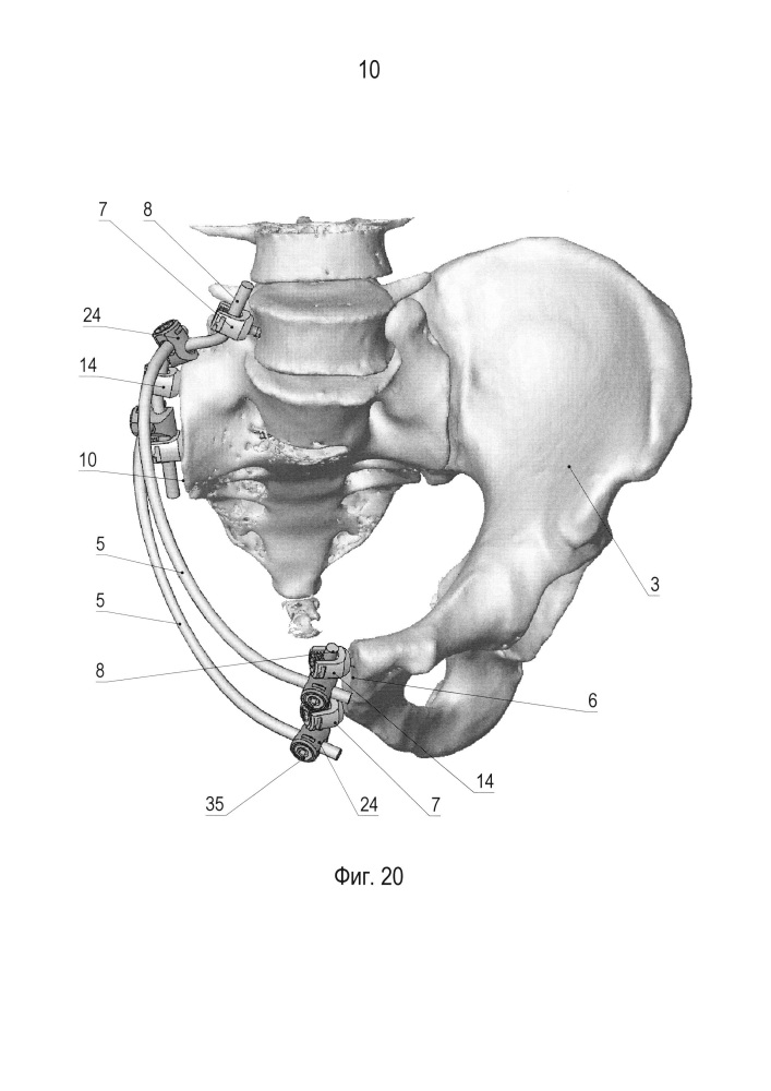 Устройство для реконструкции костей таза (патент 2626122)