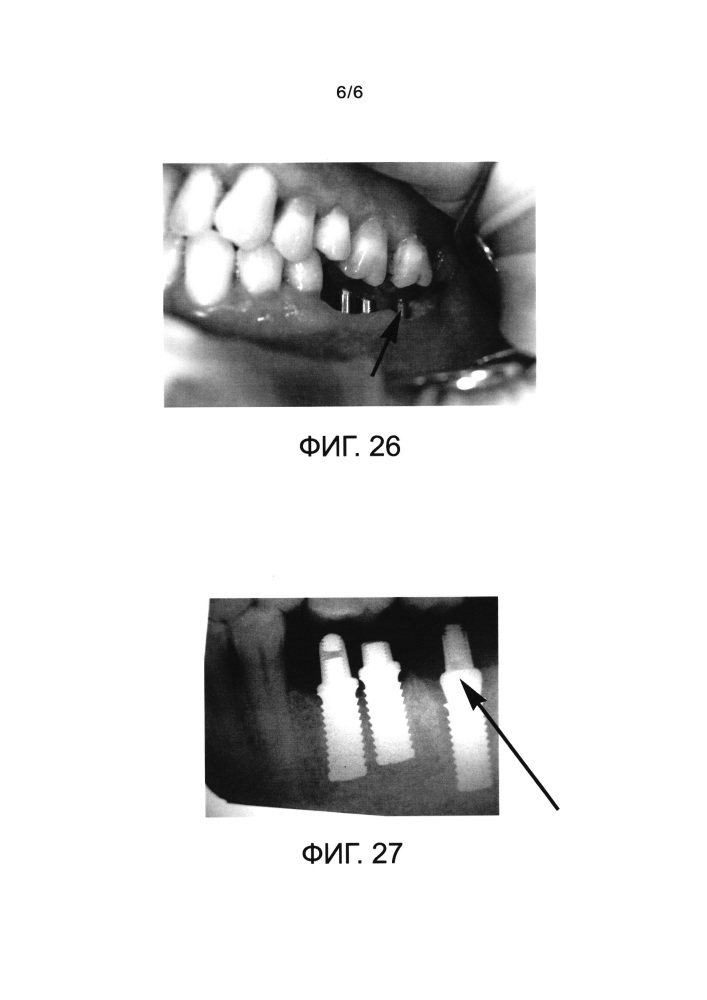 Зубной имплантат и комплект для дентальной имплантации (патент 2661019)