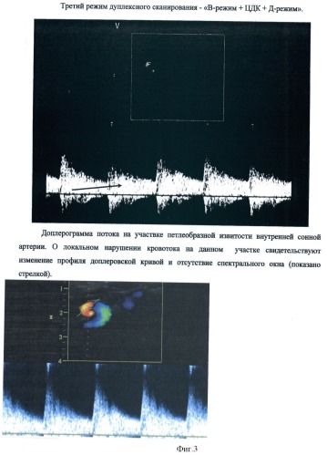 Способ определения риска микроэмболизации средней мозговой артерии у детей с патологической извитостью внутренней сонной артерии (патент 2421141)