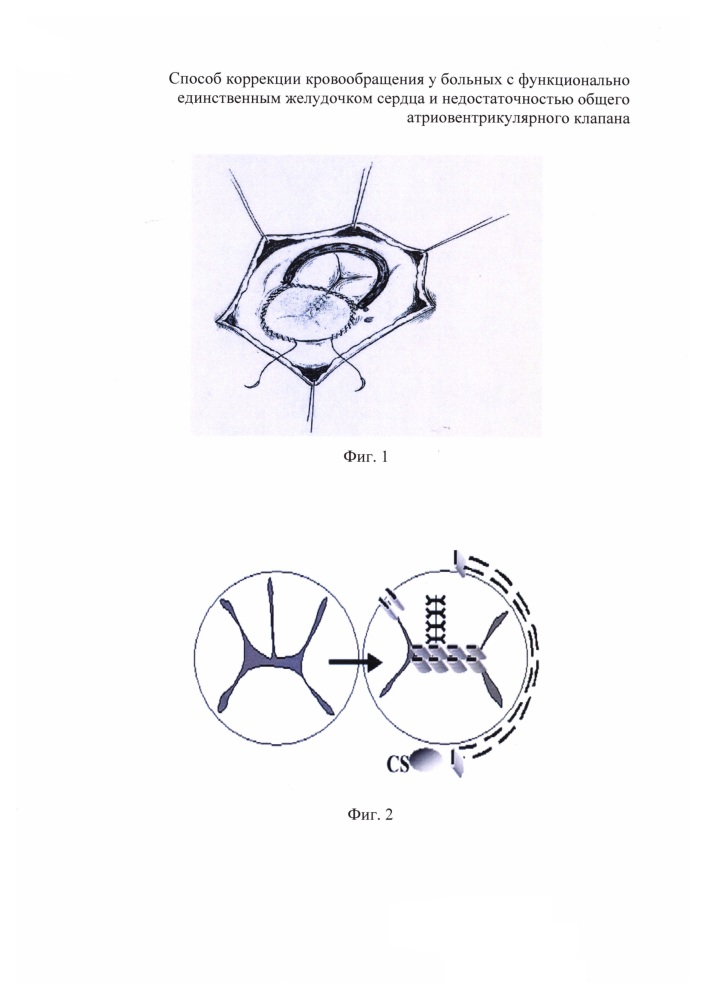 Способ коррекции кровообращения у больных с функционально единственным желудочком сердца и недостаточностью общего атриовентрикулярного клапана (патент 2620031)