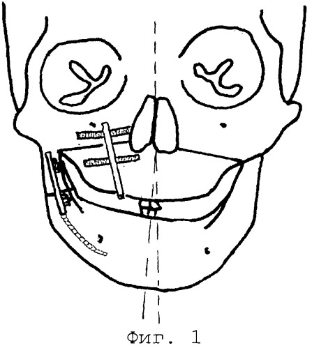 Способ устранения недоразвития и/или дефекта нижней челюсти, сочетающегося с недоразвитием верхней челюсти (патент 2267303)