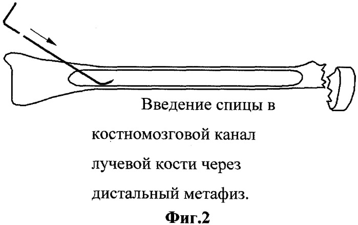 Способ лечения переломов шейки лучевой кости (патент 2342092)