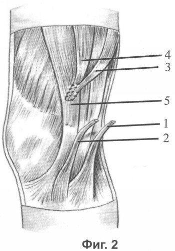 Способ хирургического лечения застарелого разрыва передней крестообразной связки коленного сустава (патент 2347541)