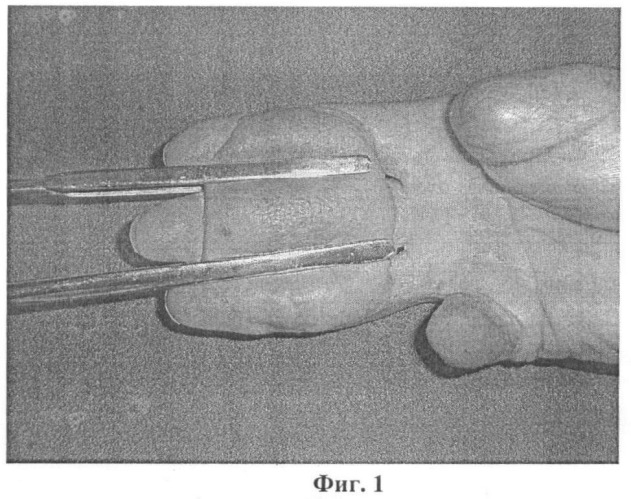 Способ кожной пластики при множественных повреждениях ладонной поверхности пальцев кисти (патент 2448656)