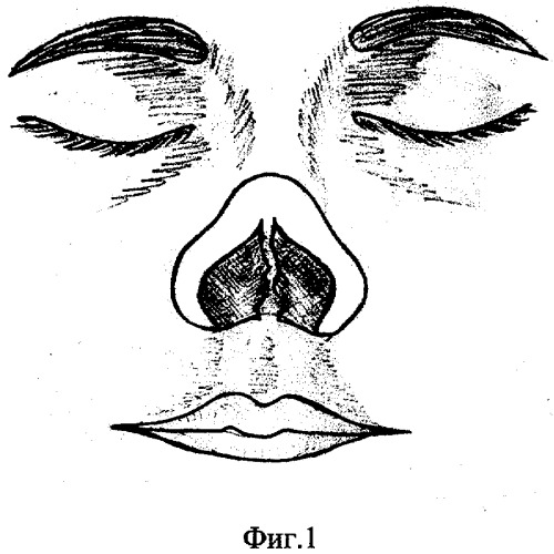 Способ пластики перегородки носа (патент 2302212)