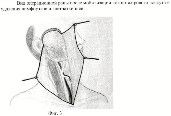 Способ хирургического лечения распространенного рака кожи околоушной области с метастазами в лимфатические узлы шеи (патент 2445005)