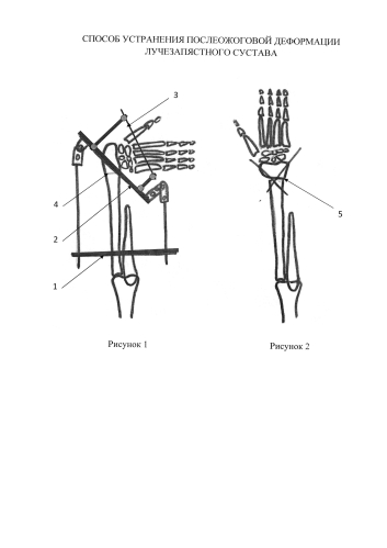 Способ устранения послеожоговой локтевой косорукости (патент 2578849)