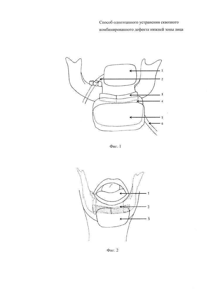 Способ одноэтапного устранения сквозного комбинированного дефекта нижней зоны лица (патент 2604028)