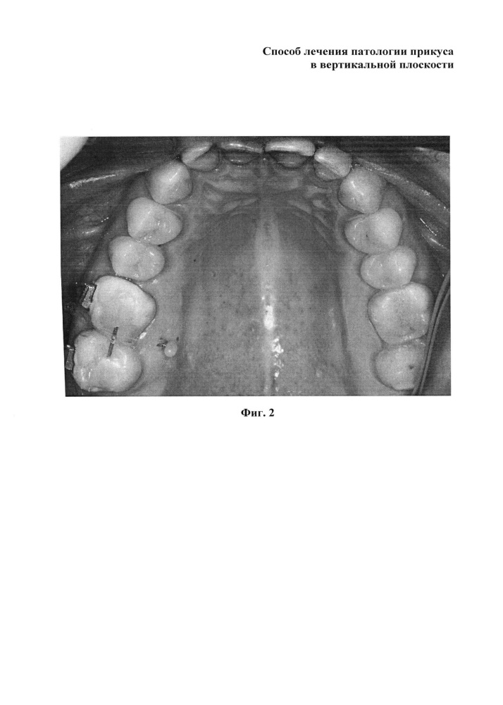 Способ лечения патологии прикуса в вертикальной плоскости (патент 2617181)