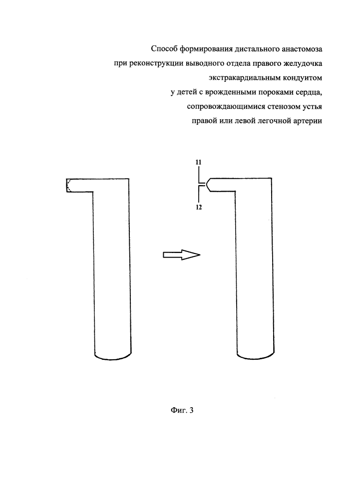 Способ формирования дистального анастомоза при реконструкции выводного отдела правого желудочка экстракардиальным кондуитом у детей с врожденными пороками сердца, сопровождающимися стенозом устья правой или левой легочной артерии (патент 2647226)