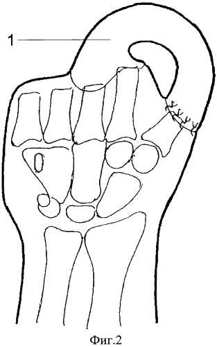 Способ реконструкции кисти при ампутационных культях всех пальцев (патент 2572551)