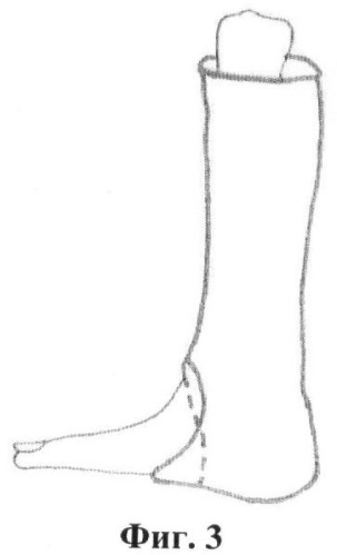 Способ лечения переломовывихов в голеностопном суставе с инверсионным подвывихом таранной кости (патент 2415651)