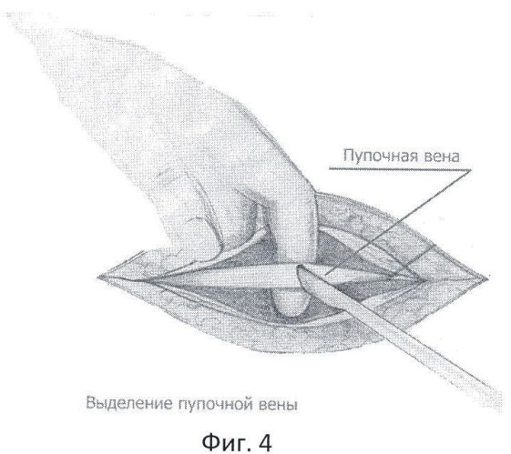 Способ лечения гнойно-некротического панкреонекроза (патент 2446756)