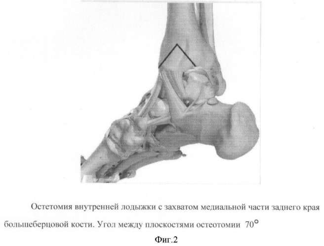 Способ оперативного доступа к таранной кости (патент 2431449)