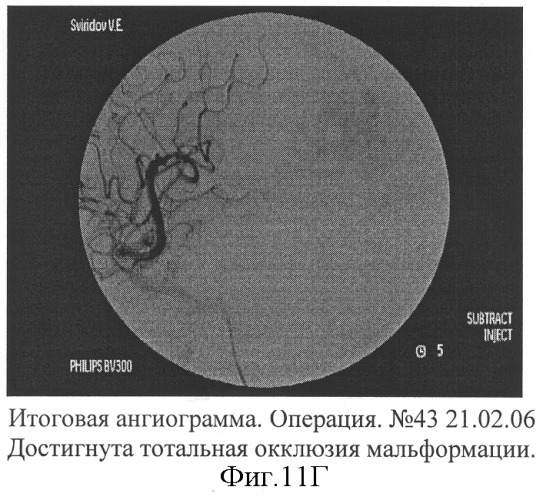 Способ эмболизации артериовенозных мальформаций головного мозга в условиях общей анестезии и управляемой гипотонии (патент 2315634)