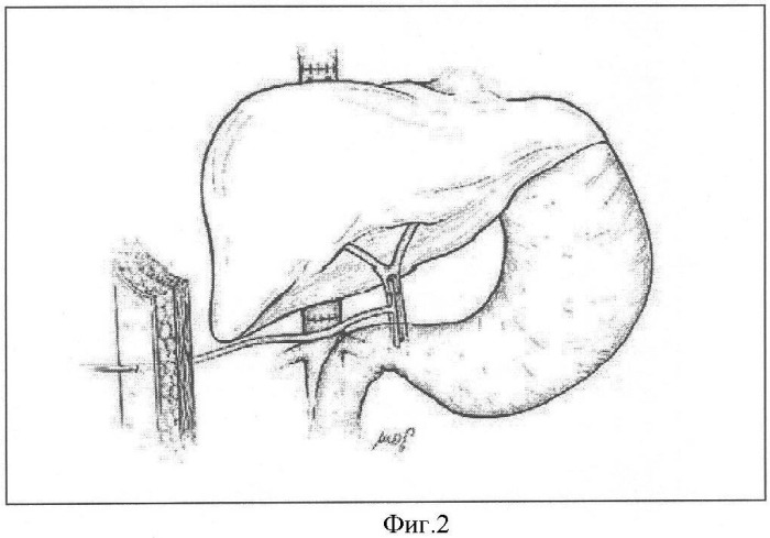 Способ восстановления оттока желчи при ортотопической трансплантации печени (патент 2347536)