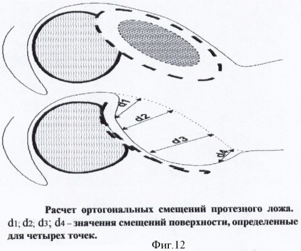 Способ функциональной реабилитации больных, перенесших операции по поводу местнораспространенных опухолей дна полости рта и нижней челюсти (патент 2371141)