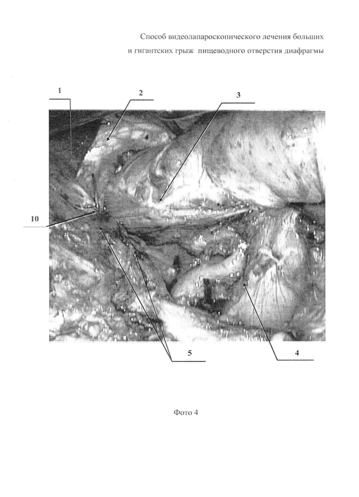 Способ видеолапароскопического лечения больших и гигантских грыж пищеводного отверстия диафрагмы (патент 2627601)