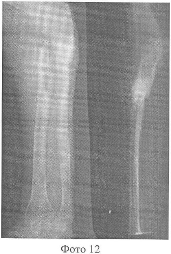 Способ хирургического лечения сегментарных дефектов диафизов костей предплечья (патент 2358677)