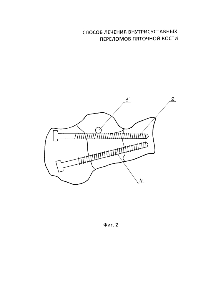 Способ лечения внутрисуставных переломов пяточной кости (патент 2630870)