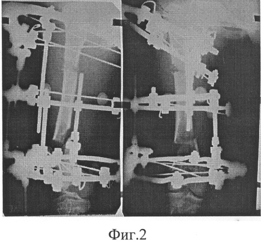 Способ удлинения трубчатой кости (патент 2258482)