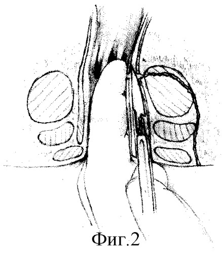 Способ пересечения гнойного хода без повреждения слизистой оболочки анального канала для лечения сложных форм острого парапроктита (патент 2306872)
