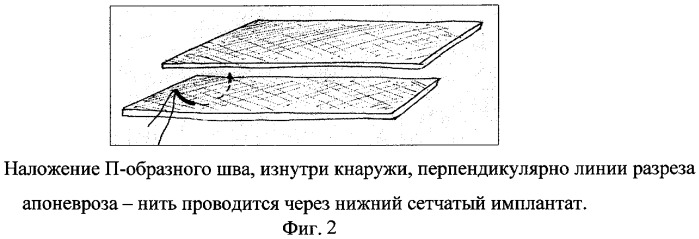 Способ ушивания апоневроза (патент 2277384)