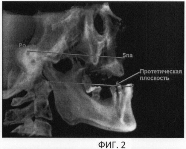 Способ определения расположения протетической верхней плоскости у пациентов с нарушениями целостности зубных рядов (патент 2470587)