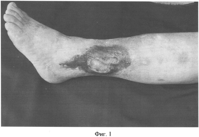 Способ лечения трофических язв нижних конечностей при посттромботической болезни (патент 2328288)