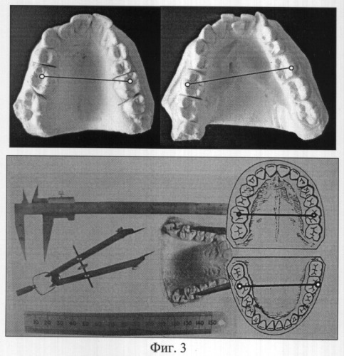 Способ оценки аномалий зубных рядов в трансверсальном направлении (варианты) (патент 2310420)
