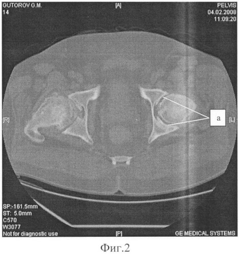 Способ обоснования эндопротезирования больных коксартрозом со 2-й рентгенологической стадией на основании данных спиральной компьютерной томографии (патент 2417753)