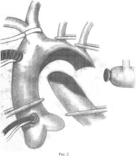 Способ коррекции коарктации аорты в сочетании с гипоплазией дуги аорты (патент 2547382)