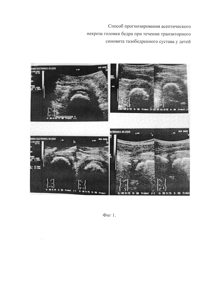 Способ прогнозирования асептического некроза головки бедра при течении транзиторного синовита тазобедренного сустава у детей (патент 2629052)