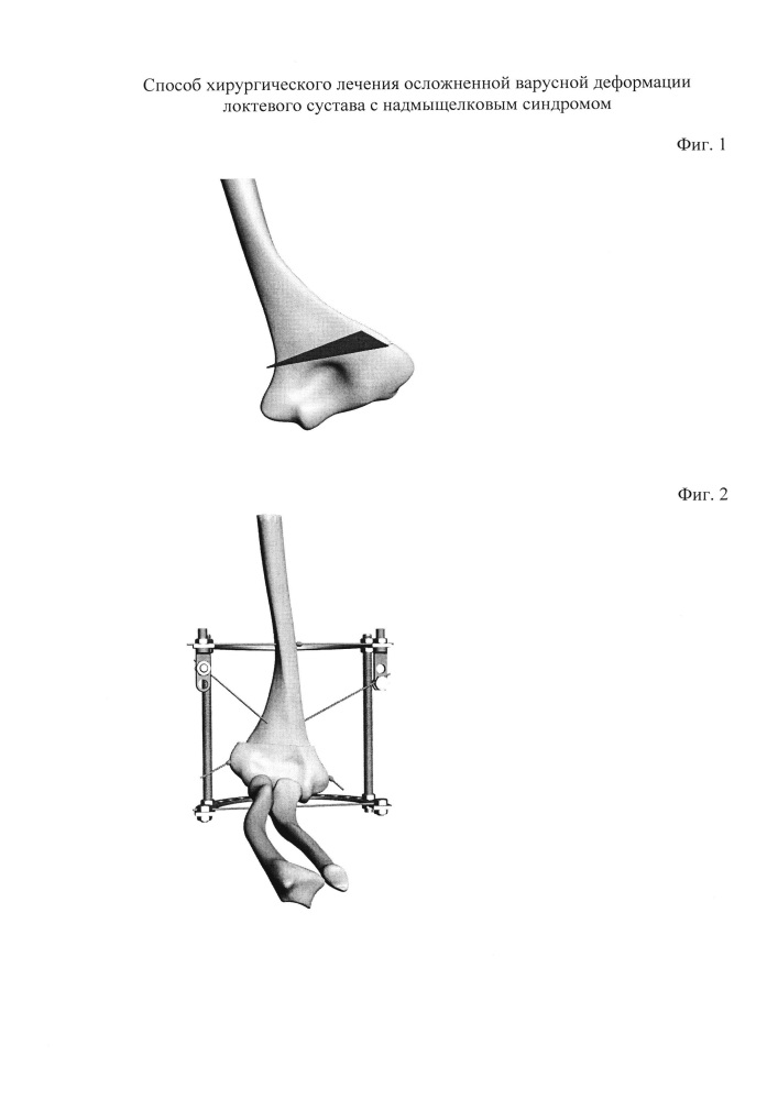 Способ хирургического лечения осложненной варусной деформации локтевого сустава с надмыщелковым синдромом (патент 2618082)